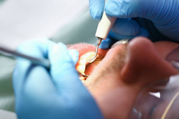 Best Emergency Wisdom Teeth Removal in Larimore, ND