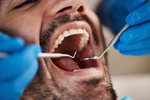 Best Emergency Wisdom Teeth Removal in Larimore, ND
